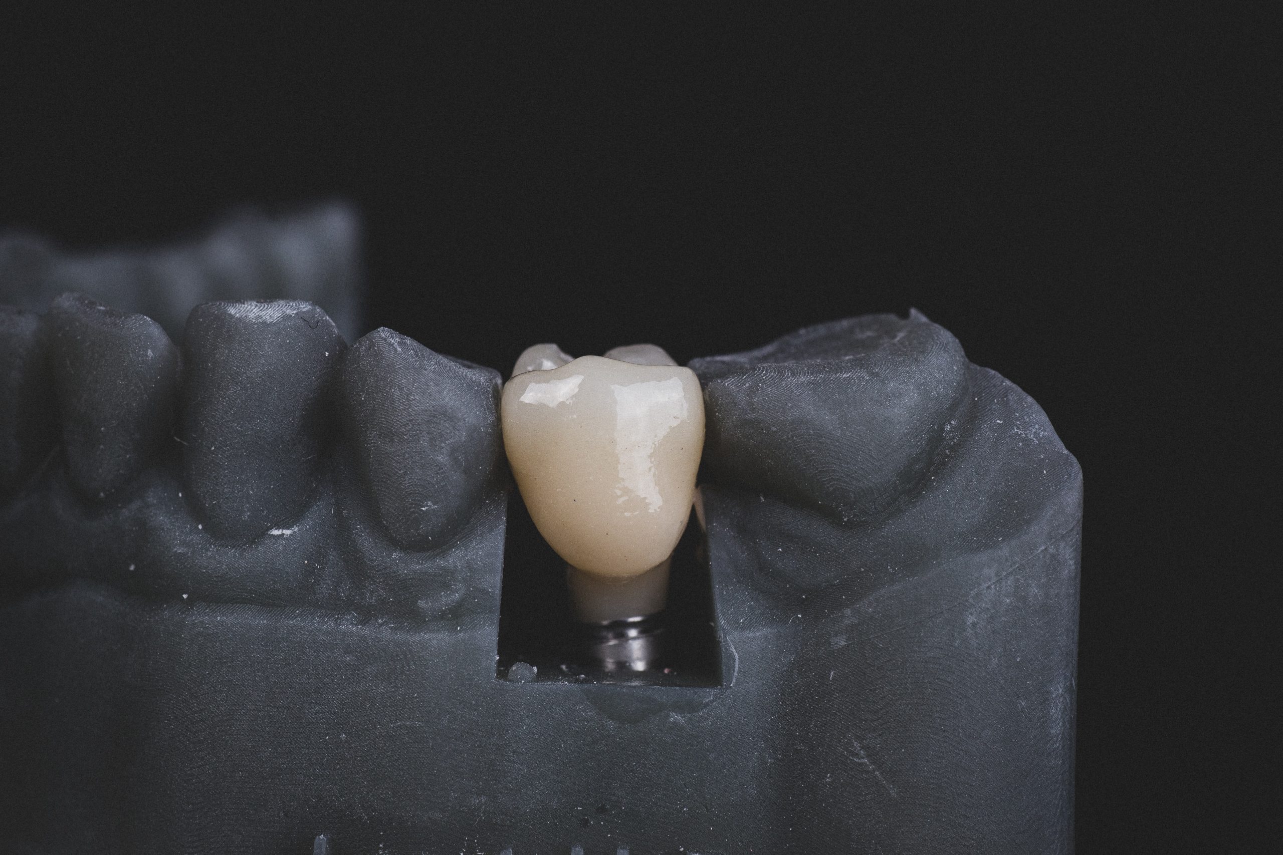 The Ultimate Guide to Dental Implants: What to Expect and How They Can Transform Your Smile
