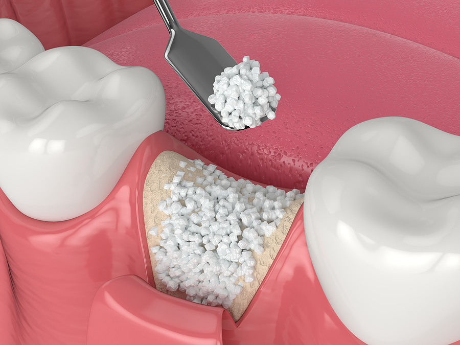 Strengthening Your Smile: Understanding Bone Grafting in Huntersville, NC